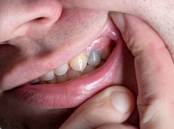 Homem mostrando dente com cor acinzentada