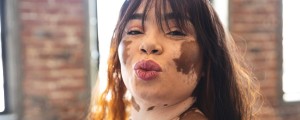 Mulher com vitiligo e franja fazendo bico