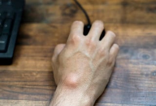 Cisto de gânglios na mão. Foto:&nbsp;taniche/Getty Images