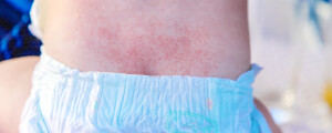 Bebê de fralda com as costas vermelhas e inflamadas pela dermatite de fralda