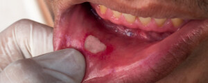 Close up ba boca de um homem com lesão branca