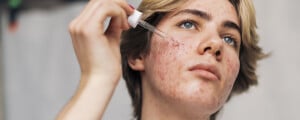 menino jovem com acne cosmética aplicando sérum no rosto