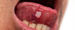 imagem aproximada da boca aberta de um homem asiático com uma afta na língua