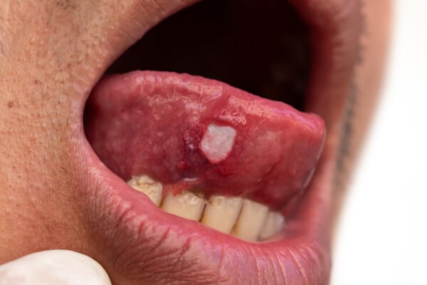 imagem aproximada da boca aberta de um homem asiático com uma afta na língua