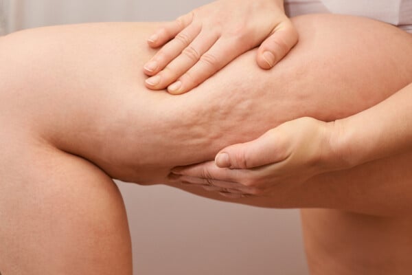 Imagem aproximada de celulites em perna feminina