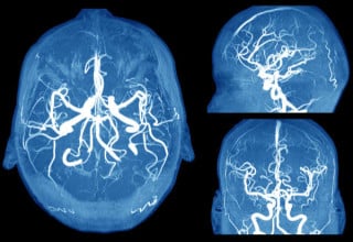 Exame de imagem aponta paredes de artérias dilatadas no cérebro, indicando aneurisma cerebral - Foto: Shutterstock