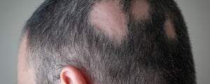 Na imagem, a cabeça de um homem com alopecia areata, mostrando três falhas de cabelo