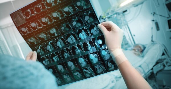 Médico olhando o raio X de um paciente com câncer de pulmão metastático