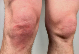 Artrite psoriásica oligoarticular costuma afetar joelhos e tornozelos - Foto: Shutterstock