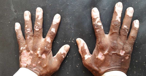 Mãos direita e esquerda de uma pessoa negra com vitiligo