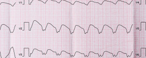 Eletrocardiograma de uma pessoa com taquicardia ventricular