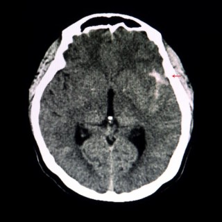 Tomografia diagnóstica de aneurisma cerebral - Foto: Shutterstock