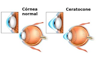 Diferença entra a estrutura de um olho saudável e um olho com ceratocone. Foto: Reprodução/Shutterstock