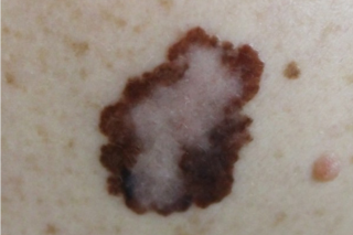 Câncer de pele melanoma - Nasekomoe/Shutterstock