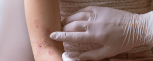 Mãos de médico, com luvas brancas, examinando feridas no braço de uma criança