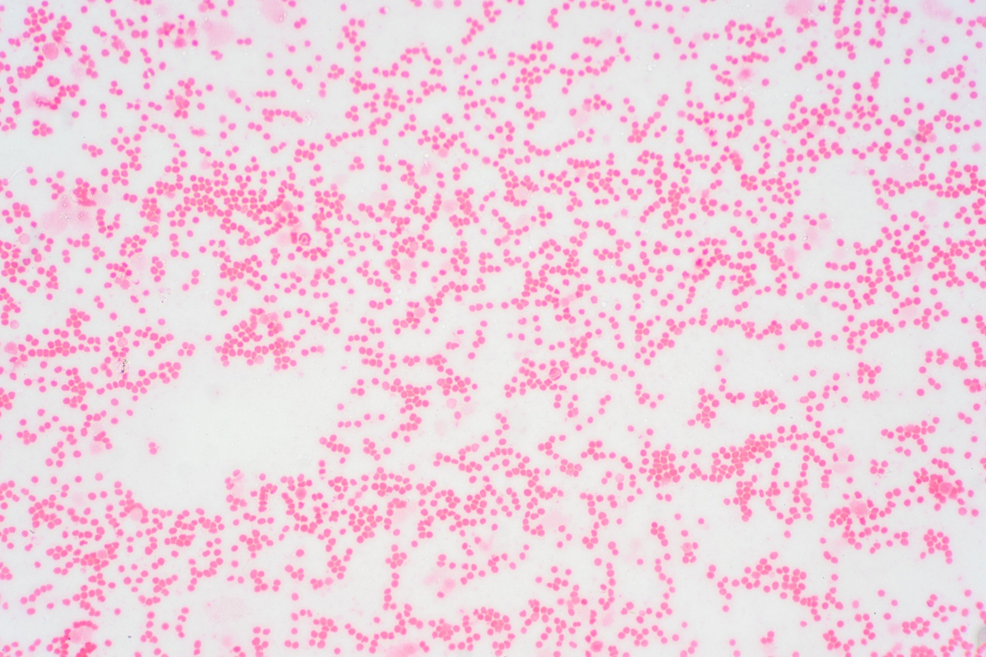 O Que é Mielofibrose? Saiba Mais sobre a Fibrose da Medula Óssea