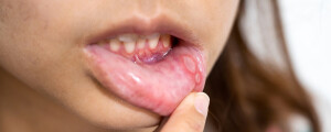 Mulher com estomatite esticando o lábio inferior com feridas