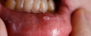 Ferida que não cicatriza é um dos sintomas de câncer de boca.