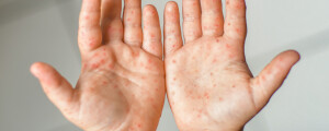 Mãos de criança com manchas vermelhas, típicas da doença mão-pé-boca