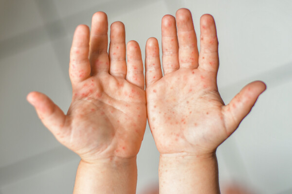 Mãos de criança com manchas vermelhas, típicas da doença mão-pé-boca