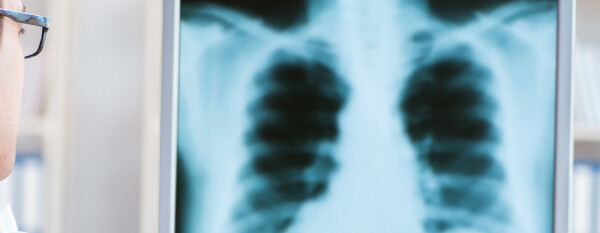 Médico observando um raio X de pulmão