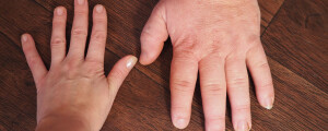 À esquerda, mão em tamanho comum; à direita, mão com acromegalia, ou seja, maior do que o habitual