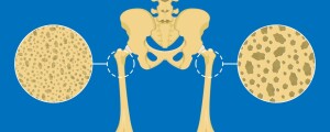 Ilustração de ossos com osteopenia
