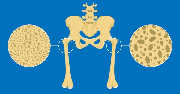 Ilustração de ossos com osteopenia