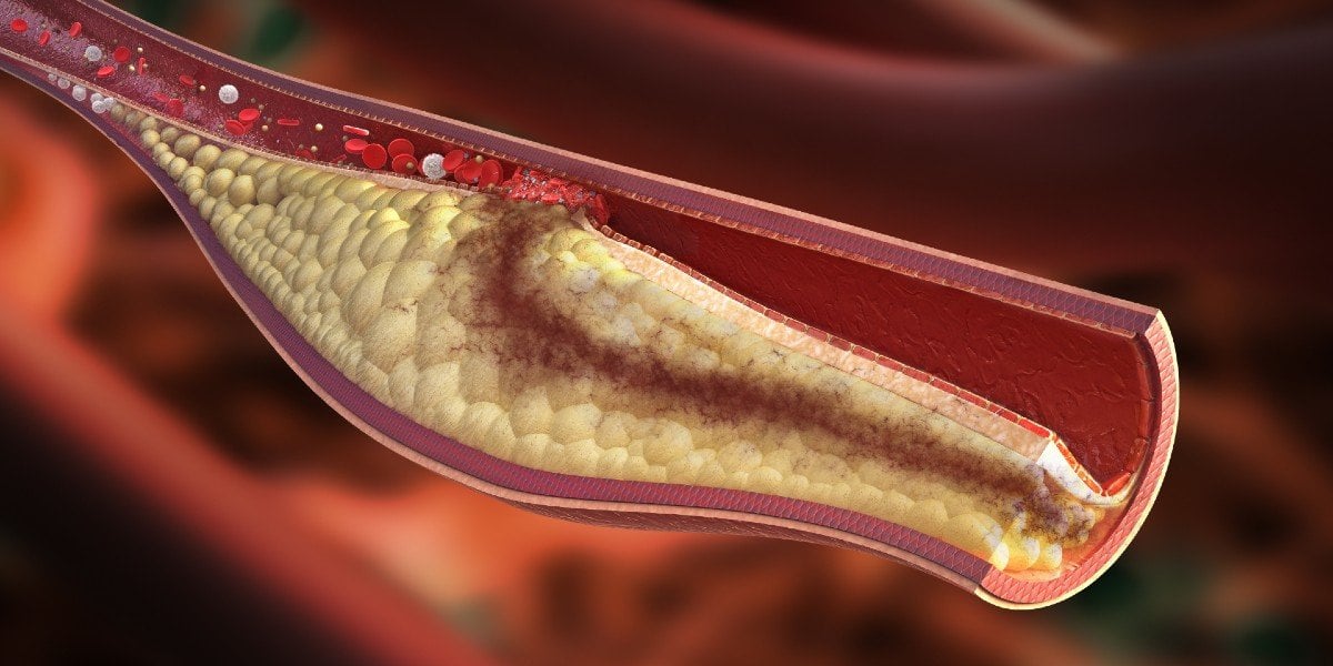 Dislipidemia O Que é Sintomas Tratamento E Causas Minha Vida 