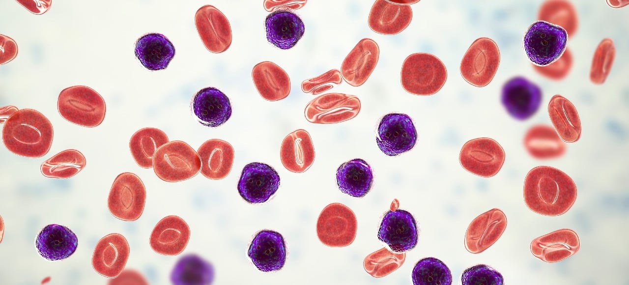 Leucemia Linfoide Crônica Sintomas Tratamentos E Causas Minha Vida 3988