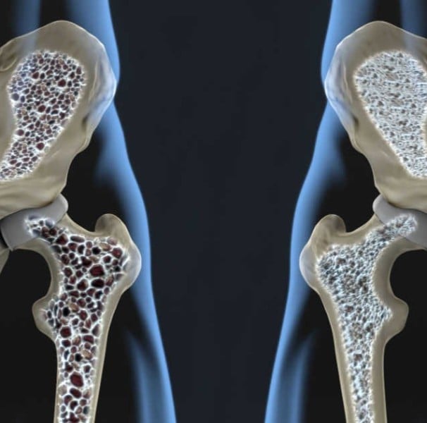 Osteoporose Veja Os Sintomas Tratamento E Se Tem Cura Minha Vida