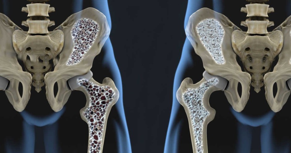 Ilustração do osso humano com osteoporose