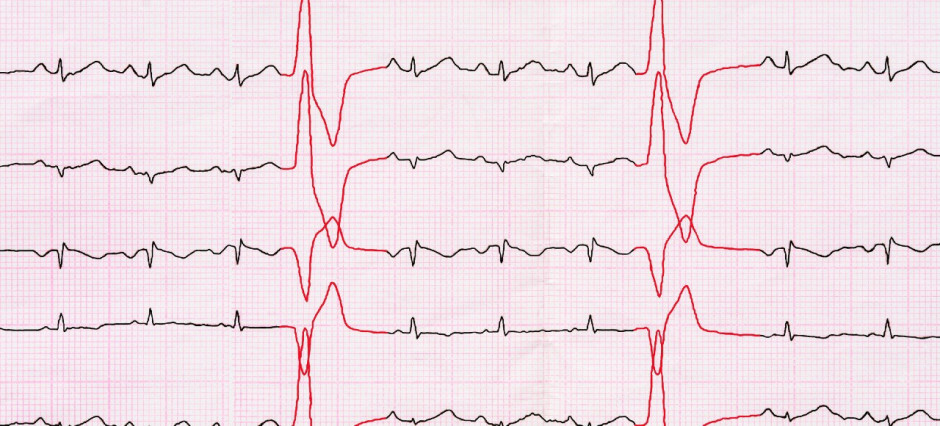 Fita ECG com batidas cardíacas
