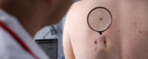 Dermatologista observando marca na pele de paciente com lupa.
