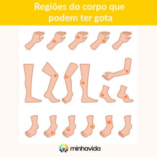 Locais do corpo que podem apresentar gota - Imagem: Minha Vida