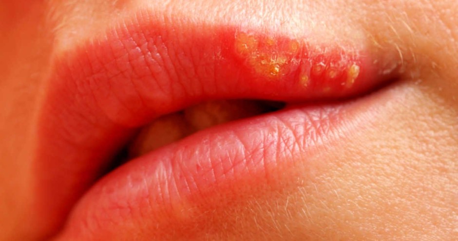 Herpes labial causa bolhas na boca, lábios ou gengiva - Foto: Shutterstock