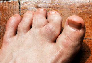 Artrite psoriásica poliarticular pode causar deformidades - Foto: Shutterstock