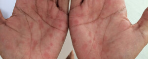 Imagem de palmas das mãos com feridas causadas pela sífilis