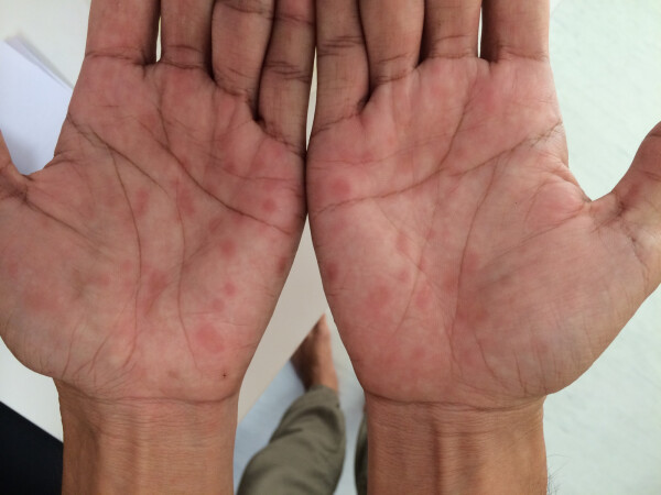 Imagem de palmas das mãos com feridas causadas pela sífilis