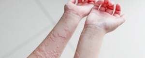 Foto aproximada de par de braços de pele branca repletos de lesões características da urticária