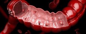 Ilustração que mostra o interior de uma porção do intestino, como um tubo com uma parte descoberta, revelando pequenas bolinhas na parede digestiva. As bolinhas são os pólipos colorretais