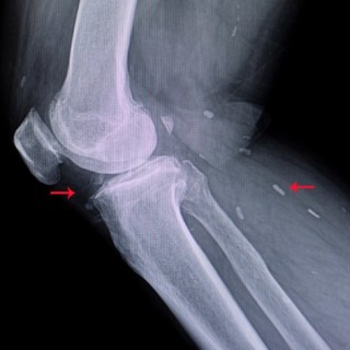 Diagnóstico de cisticercose em raio x - Foto:Shutterstock