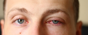 Imagem aproximada de homem com um dos olhos vermelhos pela conjuntivite.