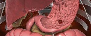 Ilustração de úlcera no estômago