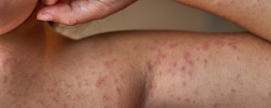 pessoa com reação alérgica/dermatite na pele