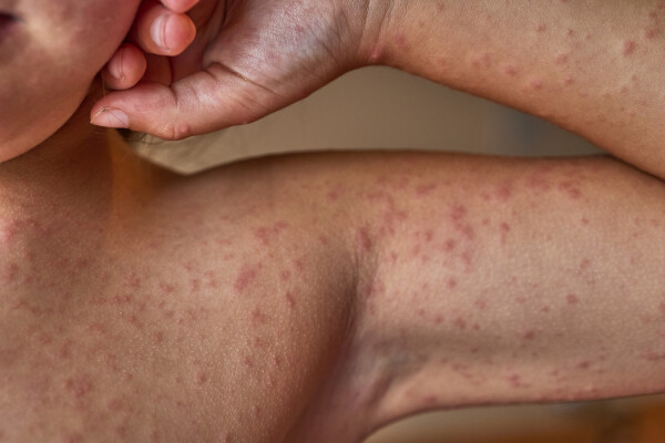 pessoa com reação alérgica/dermatite na pele