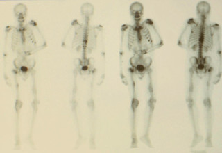 Imagens de raio-x de um paciente com evolução de metástase óssea, com fraturas como consequência - Foto: Shutterstock