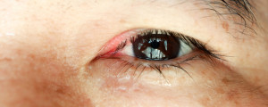 Homem com blefarite no olho