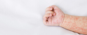 Braço e mão de uma criança sob um fundo branco. A pele clara do bebê aparece coberta de manchas vermelhas em formatos irregulares