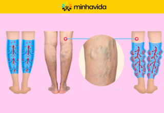 Imagens comparativas entre coagulação normal e perna com trombose - Imagem: Minha Vida